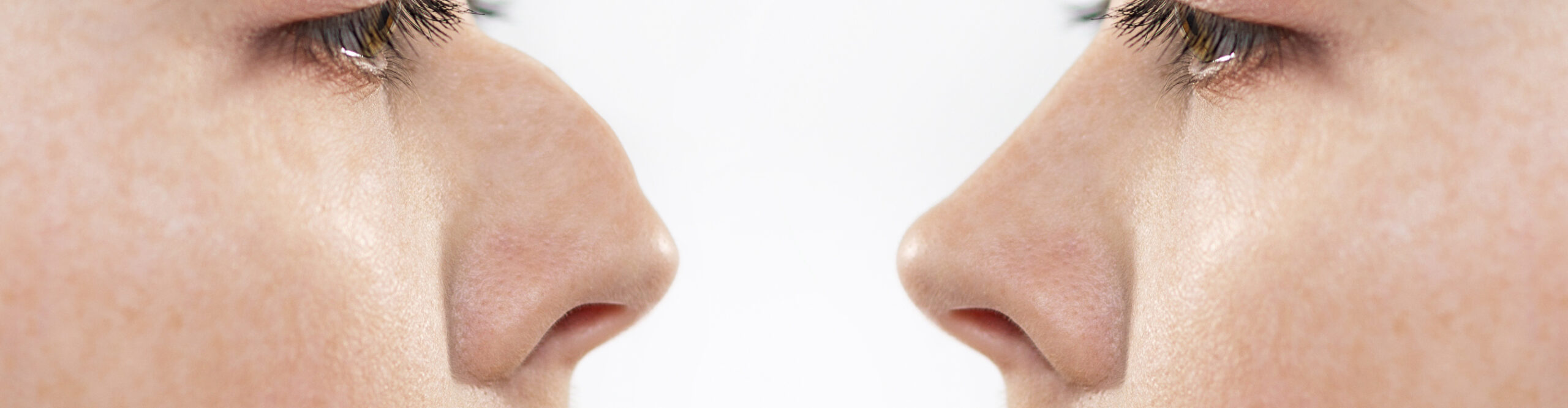 Rhinoplastie pour corriger un nez bossu : techniques et résultats