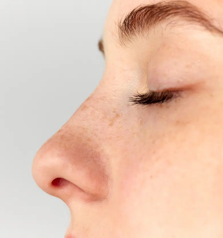 rhinoplastie médicale c est quoi pour qui adaptée | Centre Phocet | Marseille