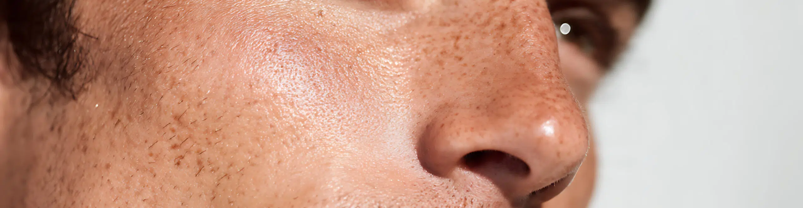 Rhinoplastie chirurgicale chez les hommes : les spécificités